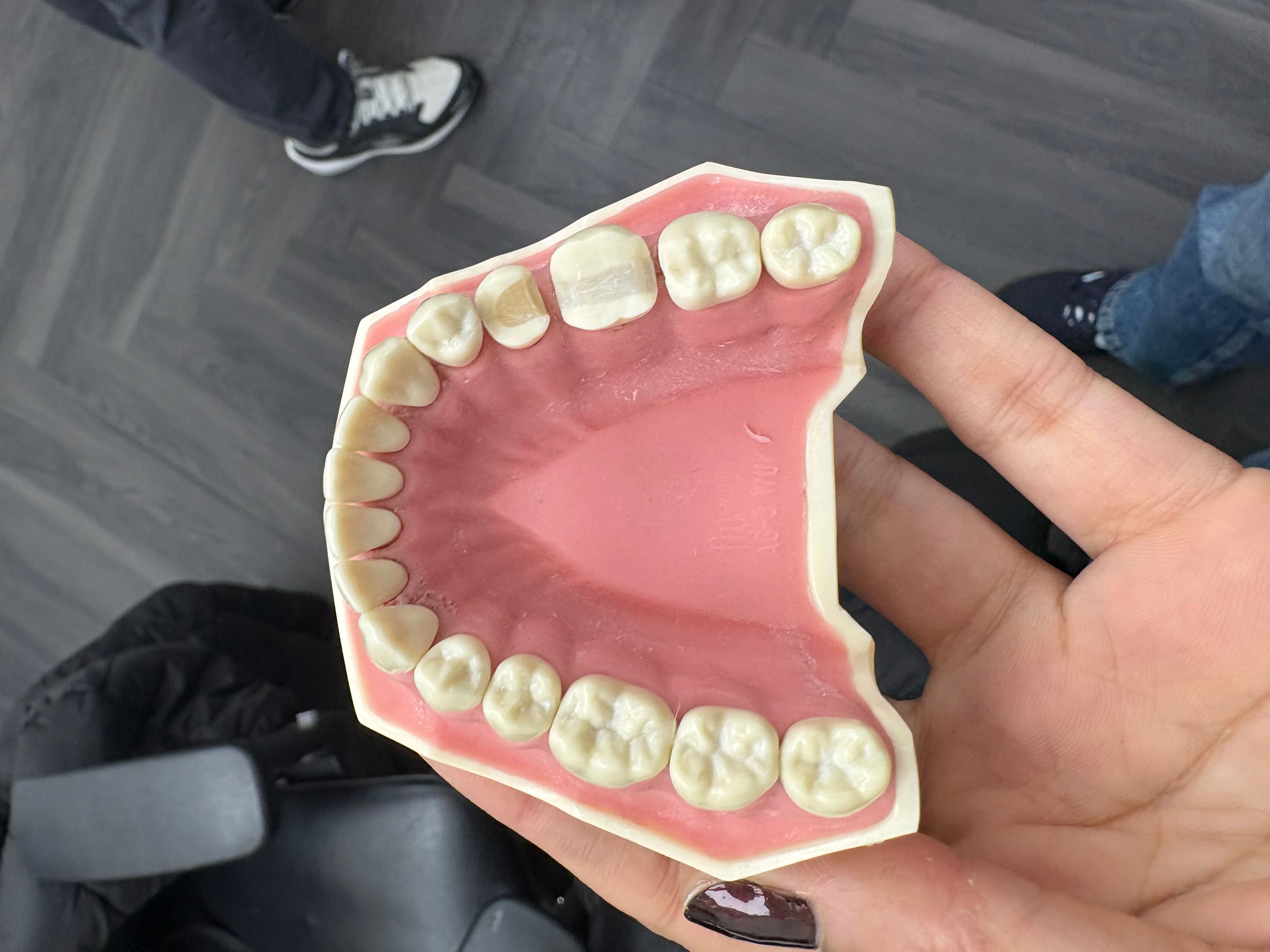 Onlay preparations LR5 LR6