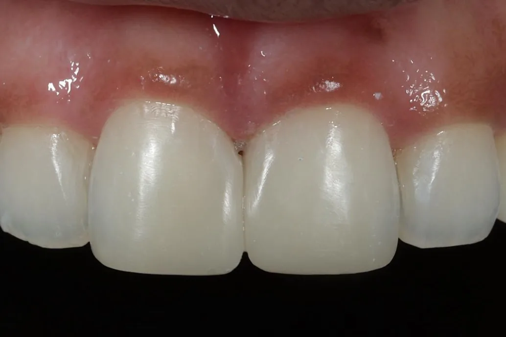 Closing a midline gap — Composite bonding