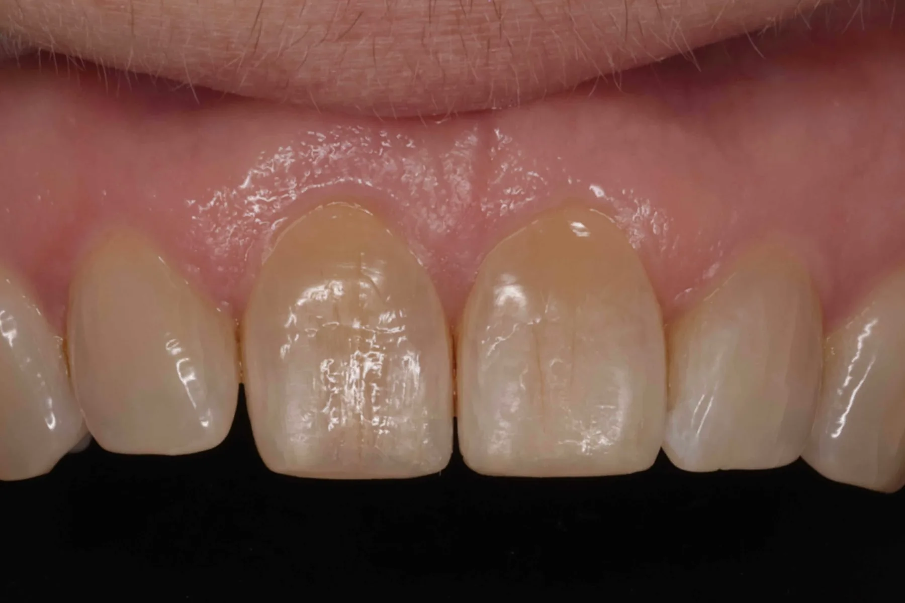 Refining worn edges — Edge bonding