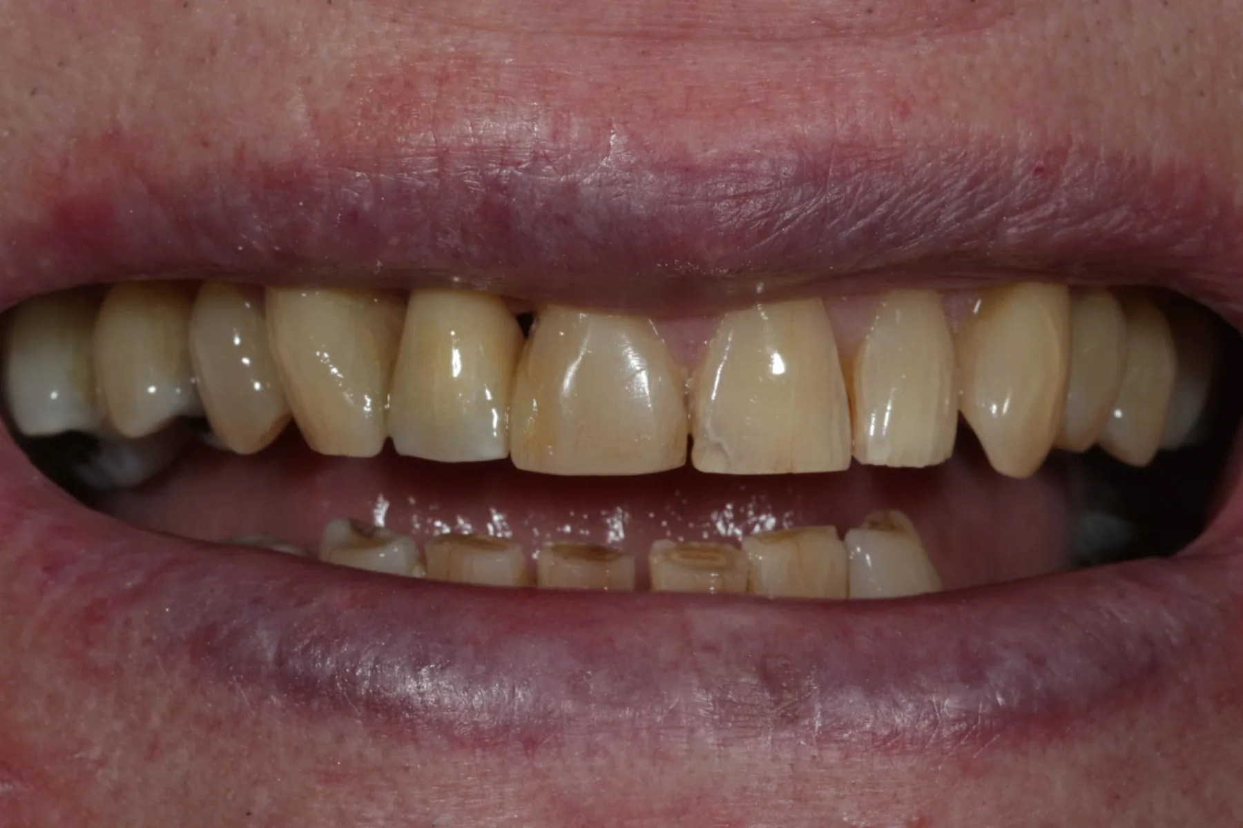 A full upper makeover — Porcelain veneers