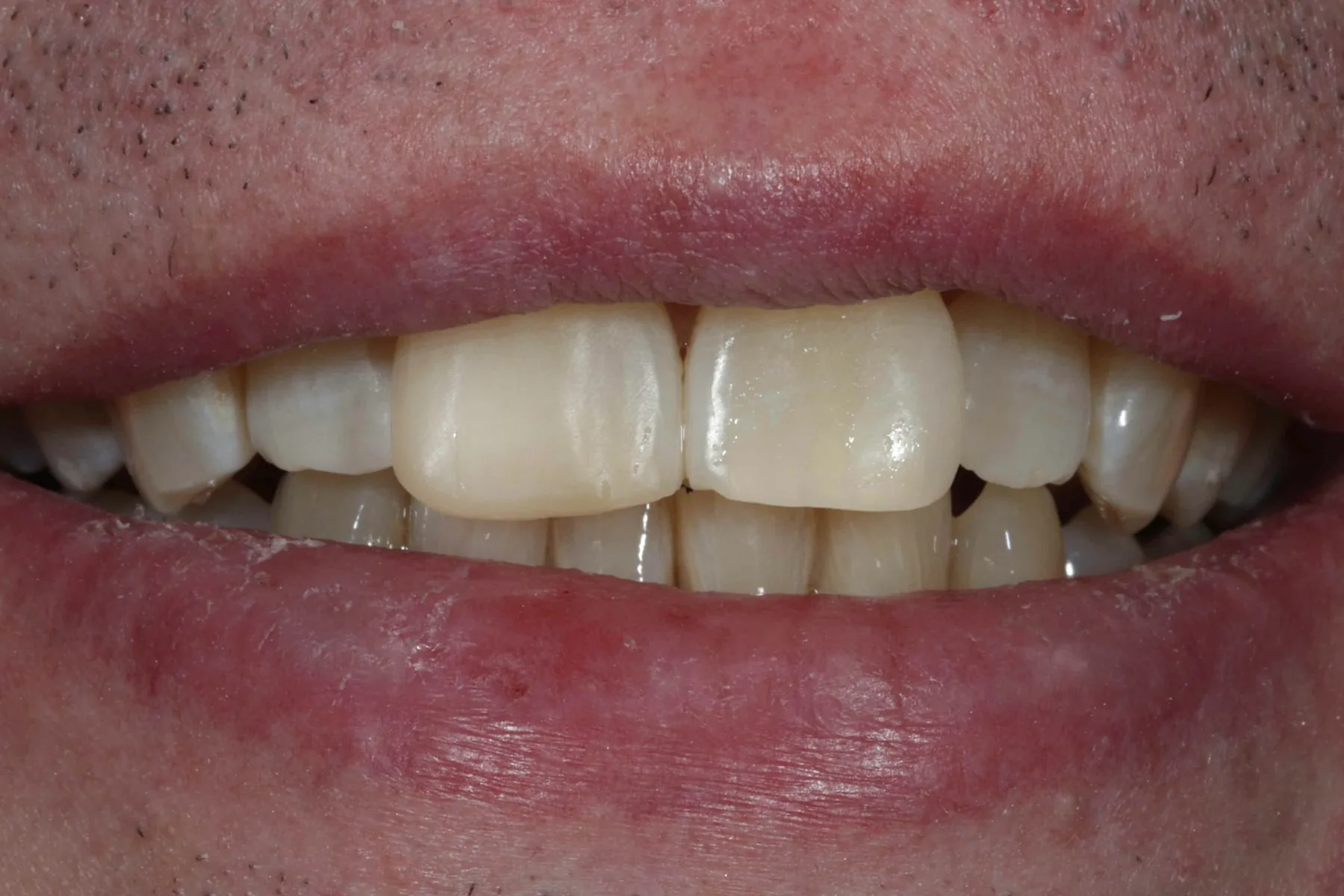 Whitening without the ache — Enlighten whitening