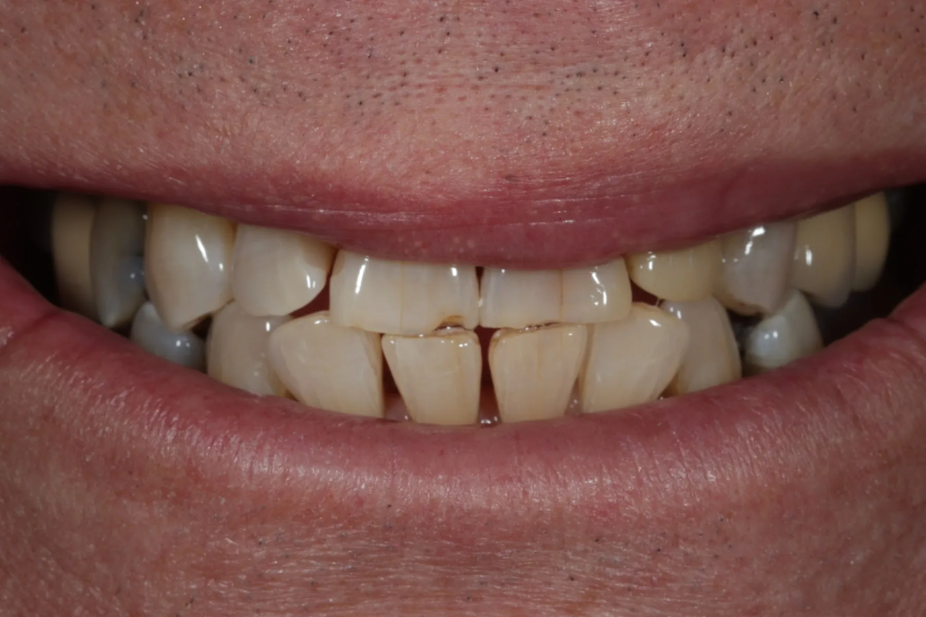 Straighten, then brighten — Invisalign & whitening