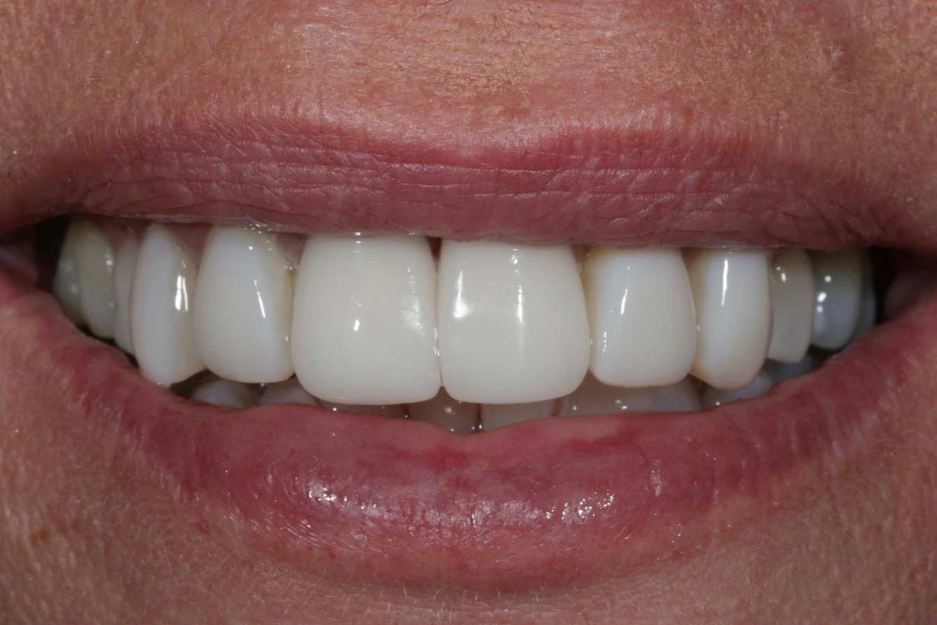 Rebuilding the whole upper smile — Full upper restoration