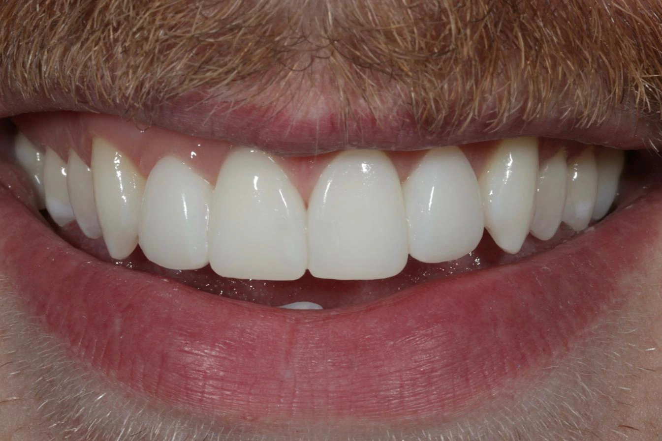 Closing the spaces across the front — Composite bonding