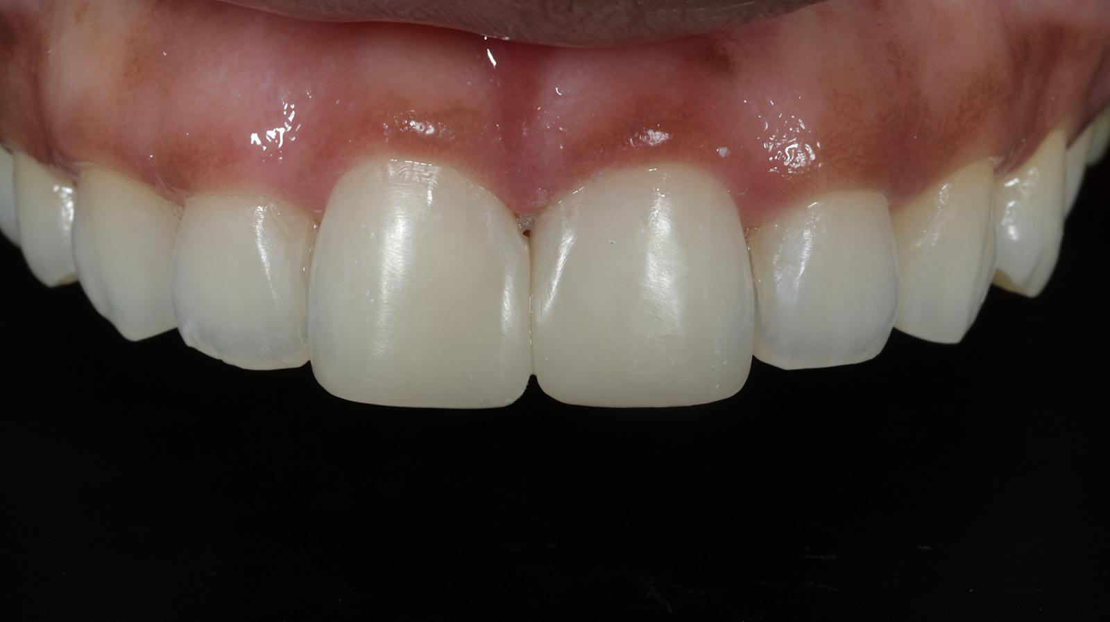 Closing a midline gap — Composite bonding